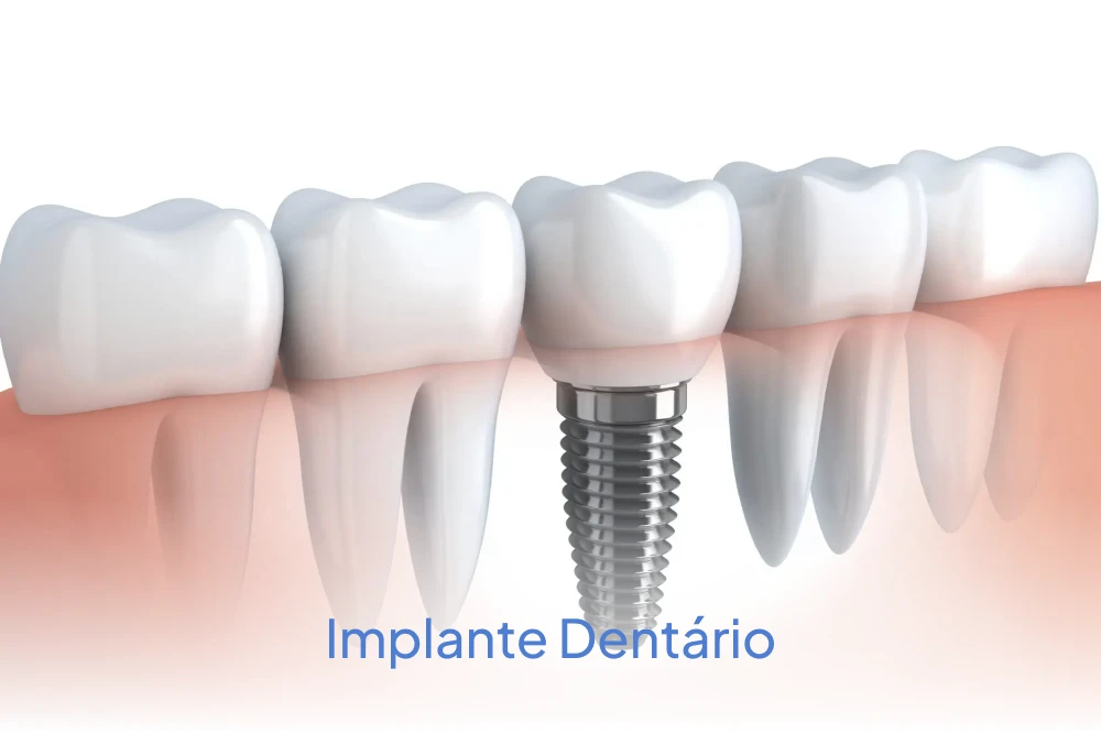 implante_dental_ipatinga
